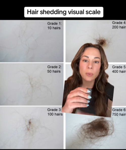 Kedy sa obávať vypadávania vlasov? Dermatologička bije na poplach