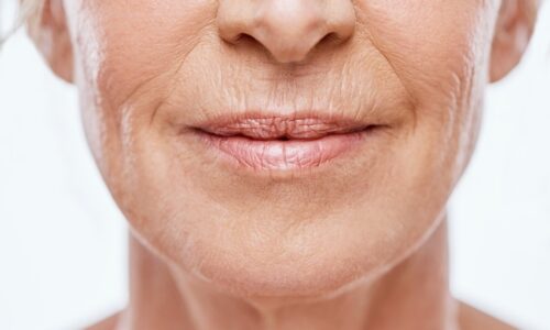 Ako odstrániť vrásky okolo úst? Zabudnite na botox. Pomôcť vám môže lacná maska z dvoch zložiek