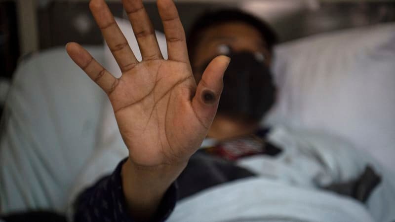 Vše, co byste měli vědět o nemoci mpox. WHO vydala nejvyšší stupeň varování, hrozí epidemie