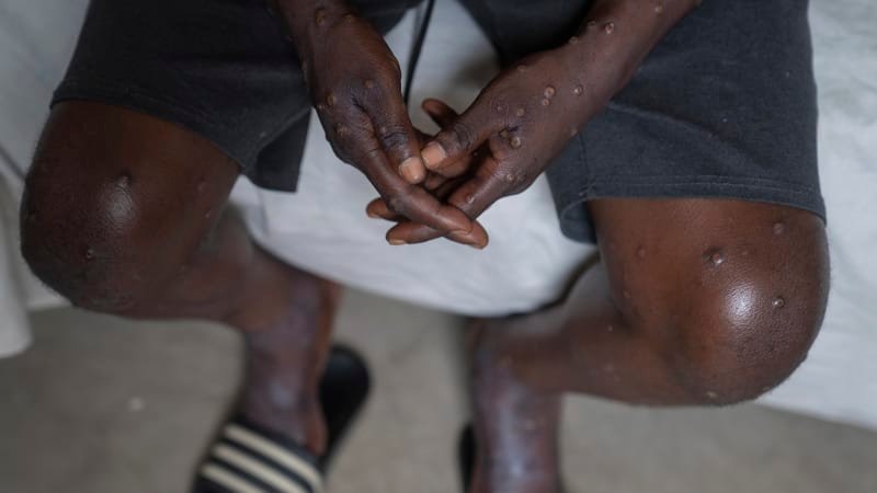 Nebezpečná nemoc mpox se poprvé objevila v Evropě. Nakažený člověk žije ve Švédsku Nebezpečná nemoc mpox se poprvé objevila v Evropě. Nakažený člověk žije ve Švédsku