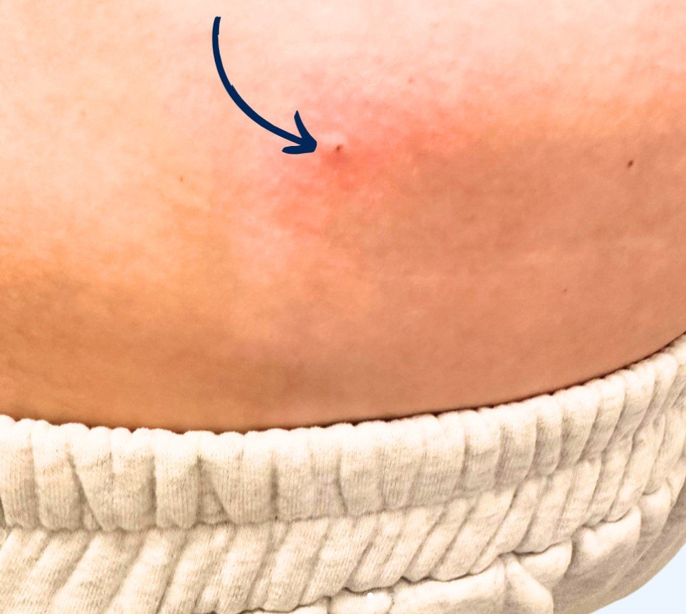 Aj takto môže vyzerať uhryznutie kliešťom. Pediatrička ukázala zavádzajúcu fotku: Myslia si, že ide o pupienok Aj takto môže vyzerať uhryznutie kliešťom. Pediatrička ukázala zavádzajúcu fotku: Myslia si, že ide o pupienok