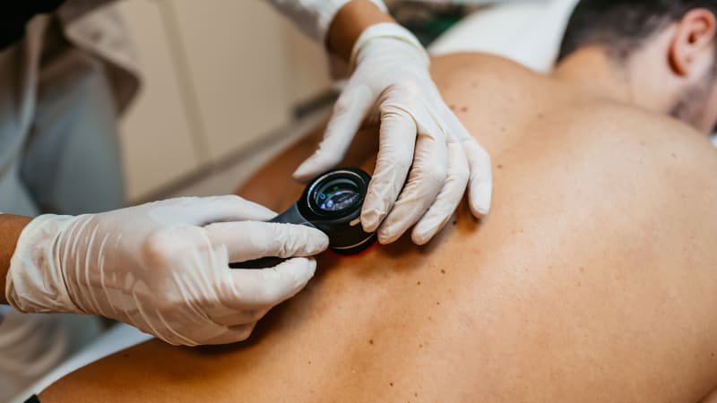 Zkontrolujte znaménka, nabádají po létě odborníci. Připomněli prevenci i na co si dát pozor Zkontrolujte znaménka, nabádají po létě odborníci. Připomněli prevenci i na co si dát pozor