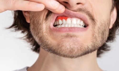 Zrádnou rakovinu úst prozradí čtyři příznaky. Experti radí, jak se správně vyšetřit i doma