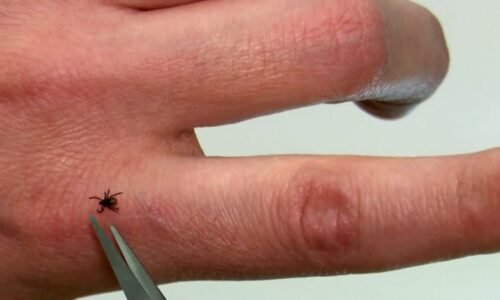 Pálení klíštěte svíčkou je špatně, říká Prymula. Prozradil zarážející důvod