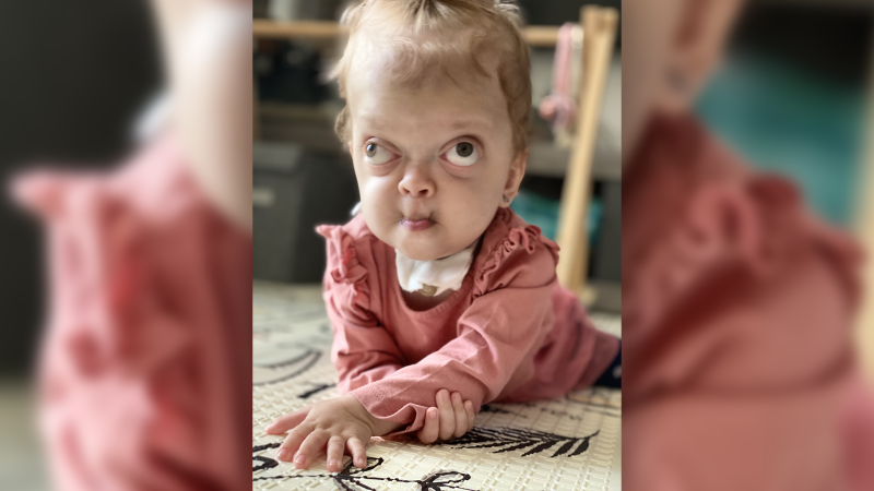Těžký boj Amálky s Crouzonovým syndromem. Péče je náročná, rodina prosí o pomoc Těžký boj Amálky s Crouzonovým syndromem. Péče je náročná, rodina prosí o pomoc