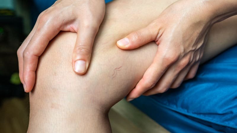 Kosmetický problém? Žilní onemocnění zatěžují i psychiku, pacienti mohou trpět depresí Kosmetický problém? Žilní onemocnění zatěžují i psychiku, pacienti mohou trpět depresí