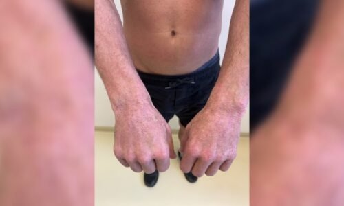 Atopický ekzém ničí lidem život, pacienti se drásají do krve. Mnozí se k léčbě nedostanou