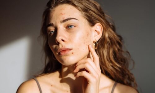 Nikdy by mi nenapadlo, že týchto 5 kožných problémov môže súvisieť so zdravím môjho srdca. vás áno?