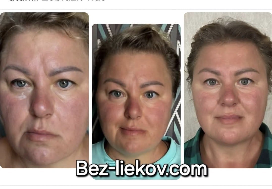 ÚŽASNÉ VÝSLEDKY po terapiách s naším prístrojom ÚŽASNÉ VÝSLEDKY po terapiách s naším prístrojom