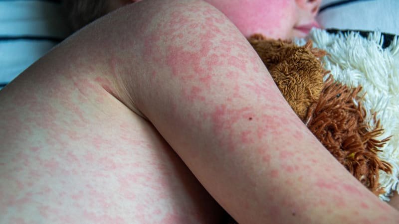 Epidemie spalniček? Nákaz přibývá, je to horší než před covidem, bijí na poplach experti Epidemie spalniček? Nákaz přibývá, je to horší než před covidem, bijí na poplach experti