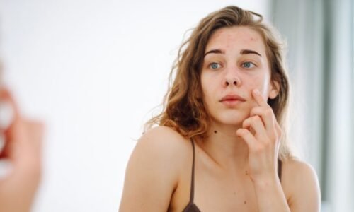 Z pultů musí čtveřice léků. Je mezi nimi i roztok na akné, SÚKL zjistil pochybení ve výrobě Z pultů musí čtveřice léků. Je mezi nimi i roztok na akné, SÚKL zjistil pochybení ve výrobě